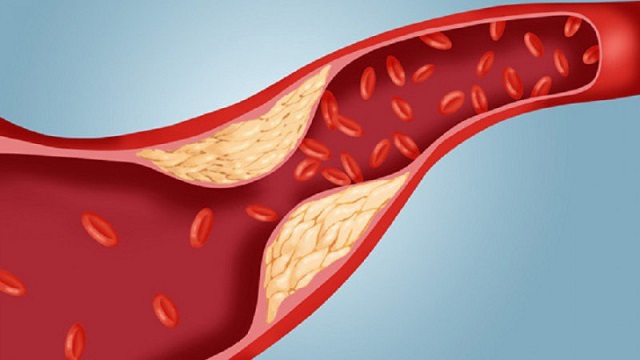 Vì sao phải giảm cân, tác hại nguy hiểm của béo phì