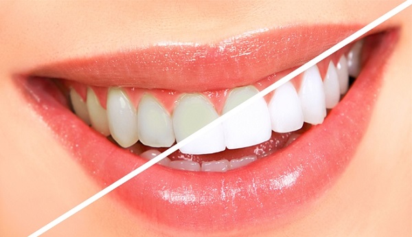 Làm sao sử dụng bột trắng răng an toàn tại nhà